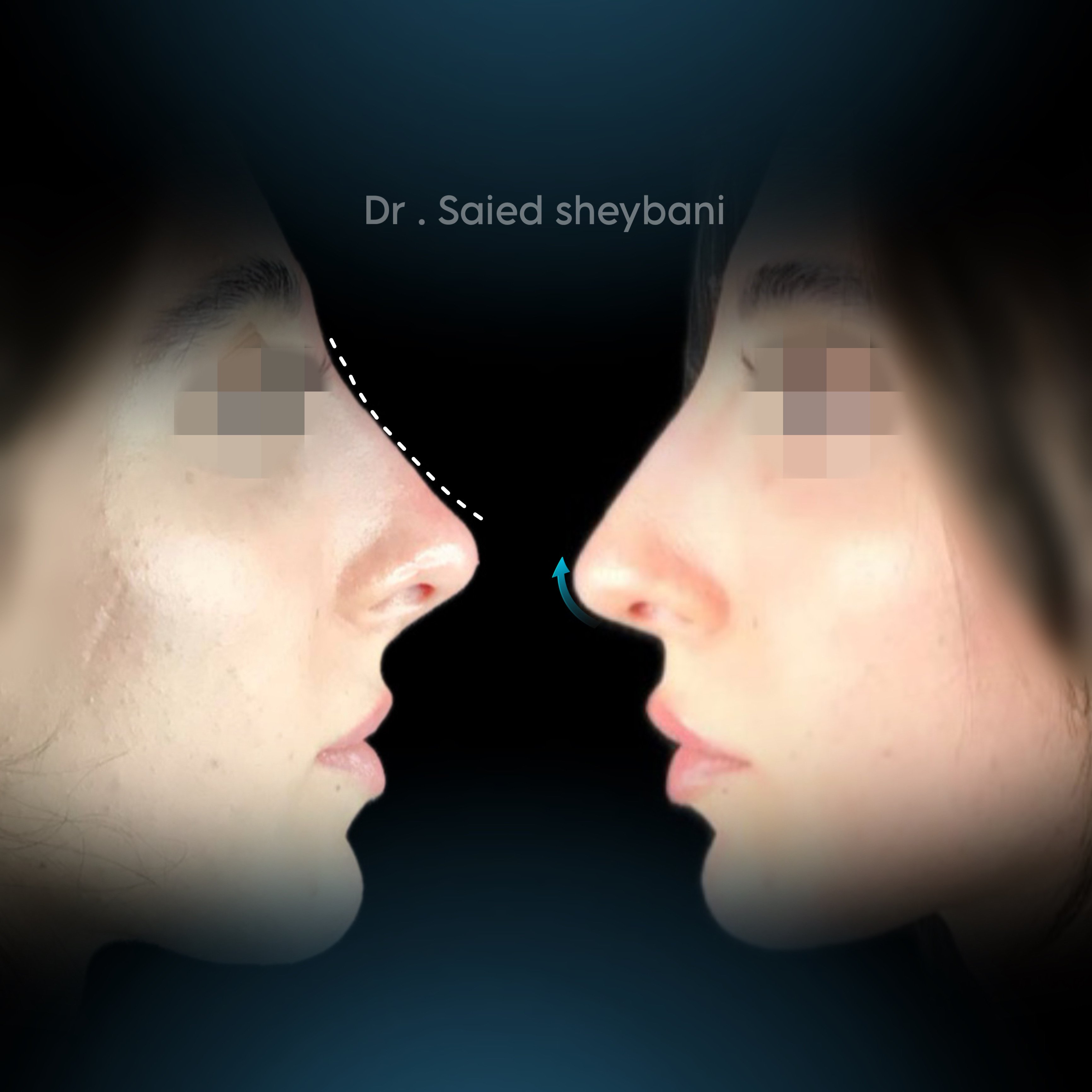 گالری Down Lift - تصویر 1