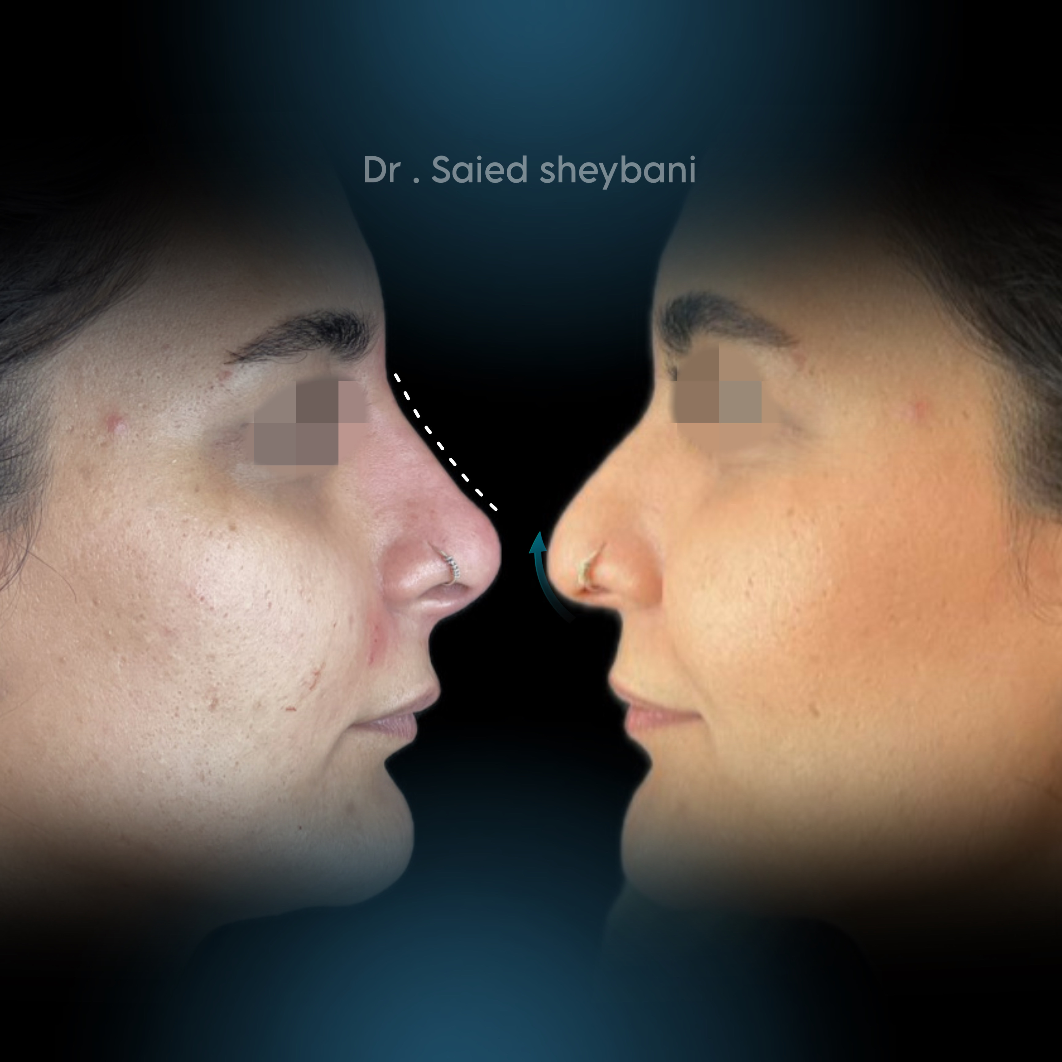 گالری Down Lift - تصویر 2